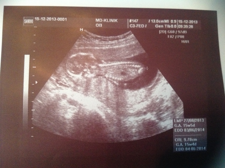 Сходила на очередной прием к врачу и сделали узи!!!! Тттттттт!!!