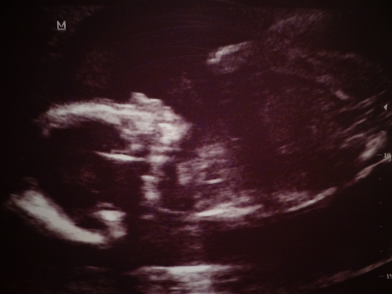 20 недель и 6 дней