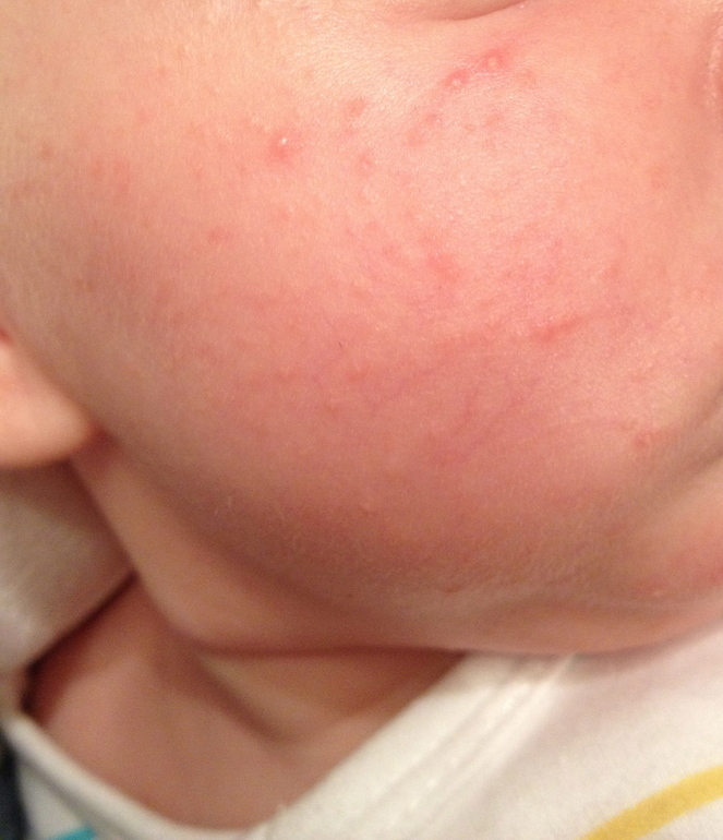 Непонятные высыпания