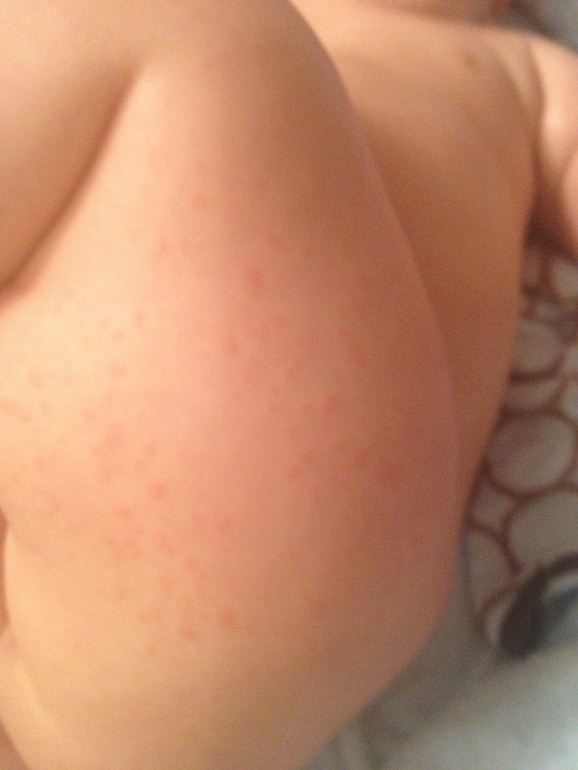 Ужасные высыпания...