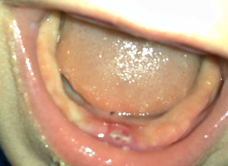 Коренные зубы у детей – симптомы прорезывания зубов, осложнения, уход