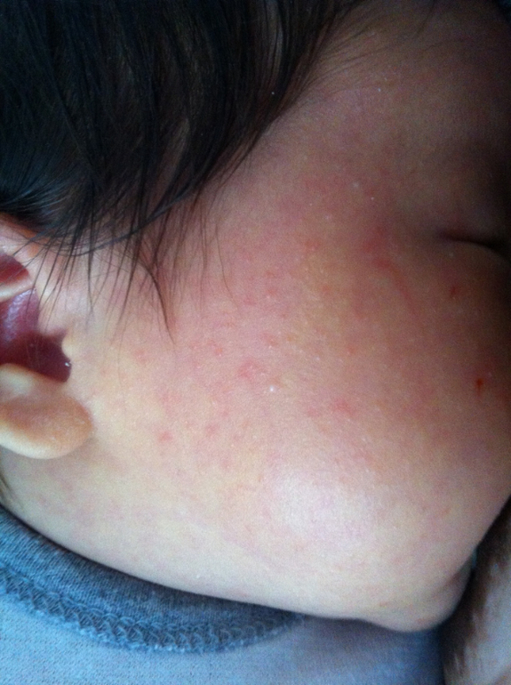 Сыпь на лице!!! Посоветуйте что нибудь!