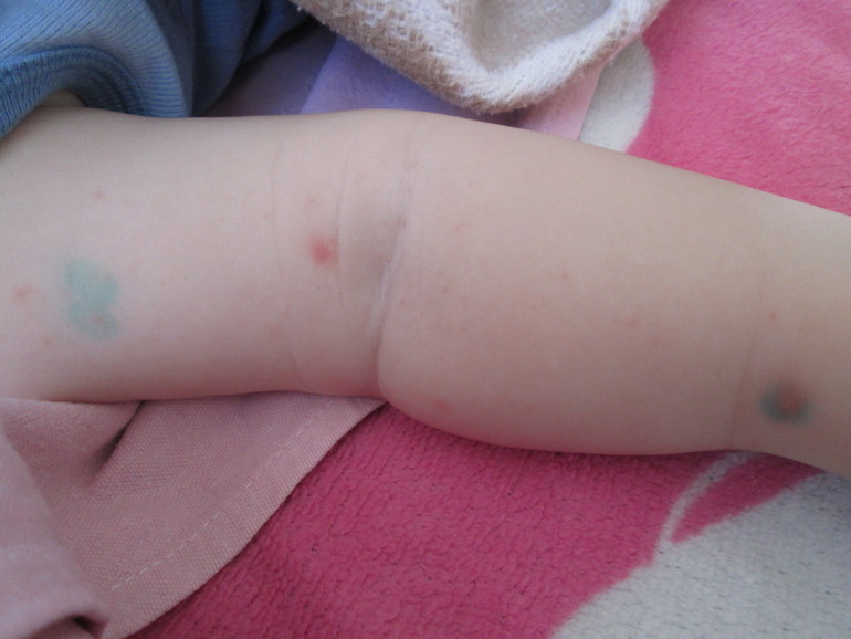 Что за сыпь???