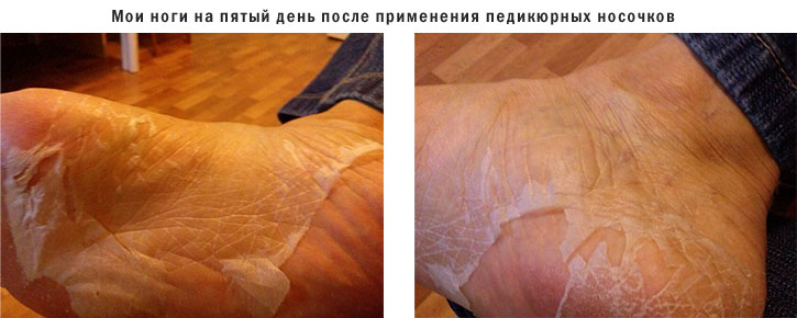 Как избавится от шелушения на пятках в домашних условиях