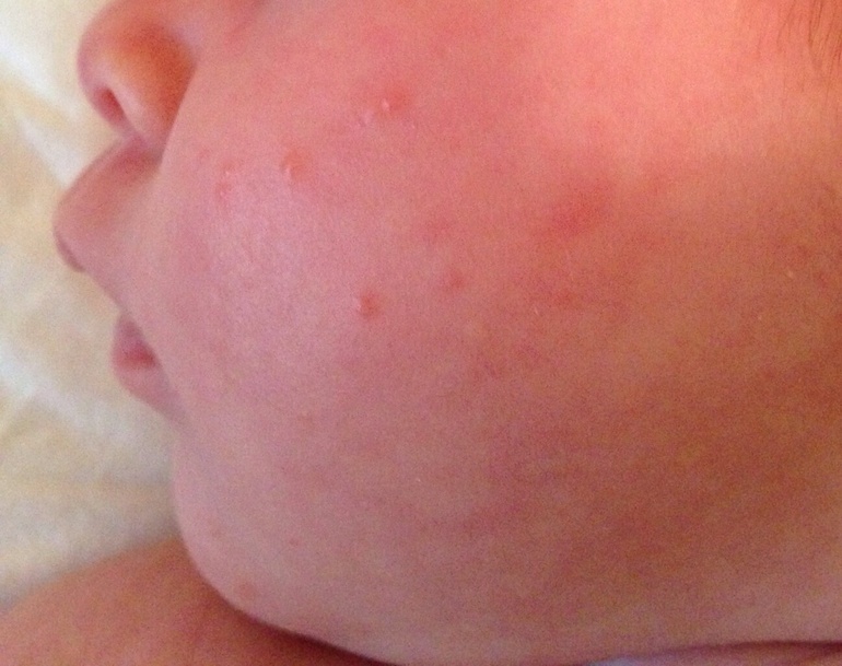 Акне или аллергия?