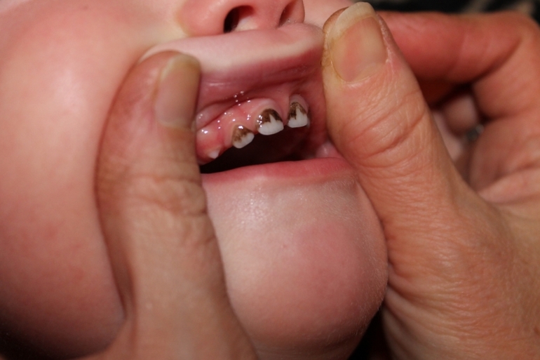 Налет на зубах