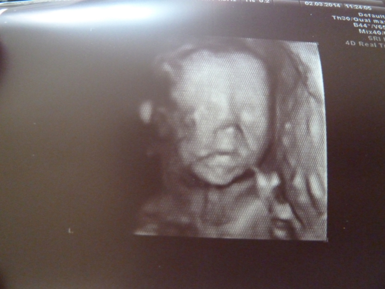 Повторное УЗИ