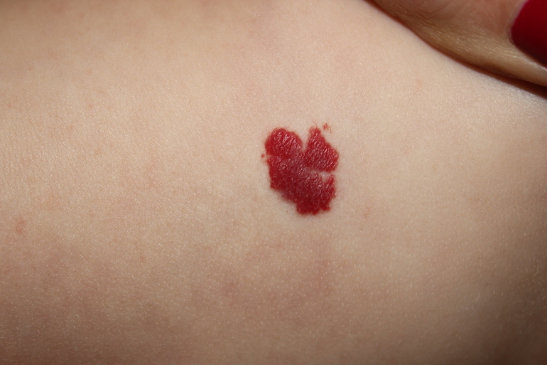 Гемангеома