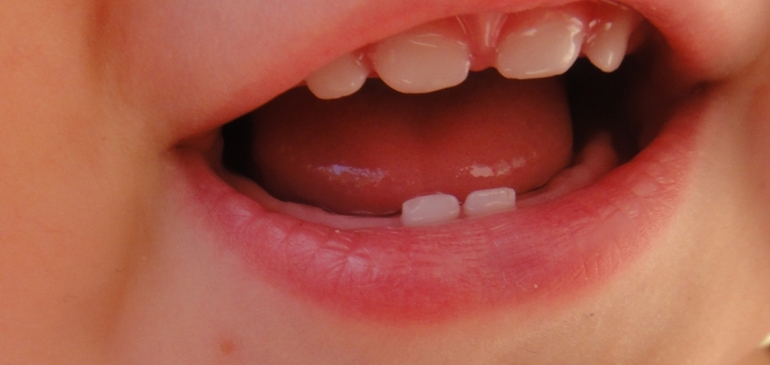 Отколы на двух резцах