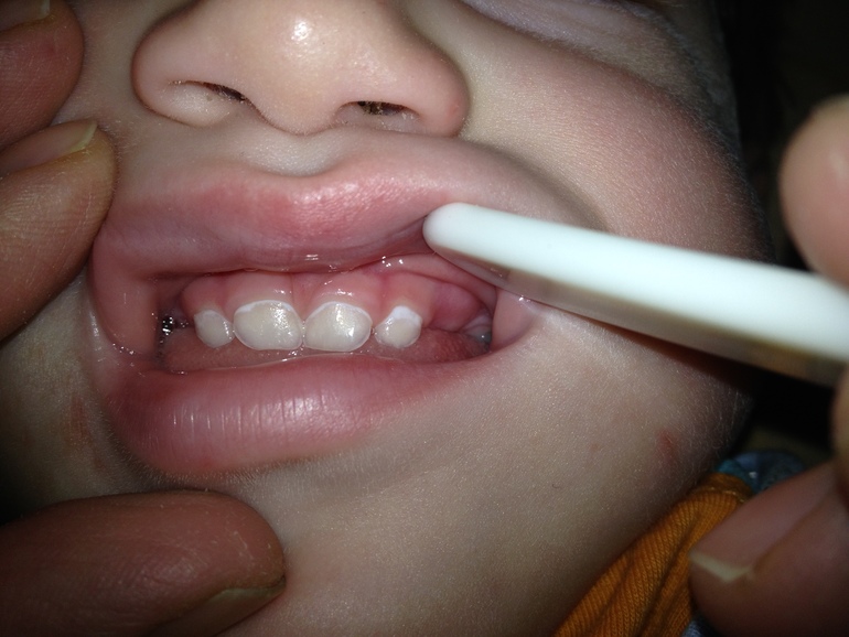 Начальная стадия кариеса? 1 год 7 мес