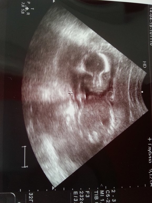 2-ое плановое узи)