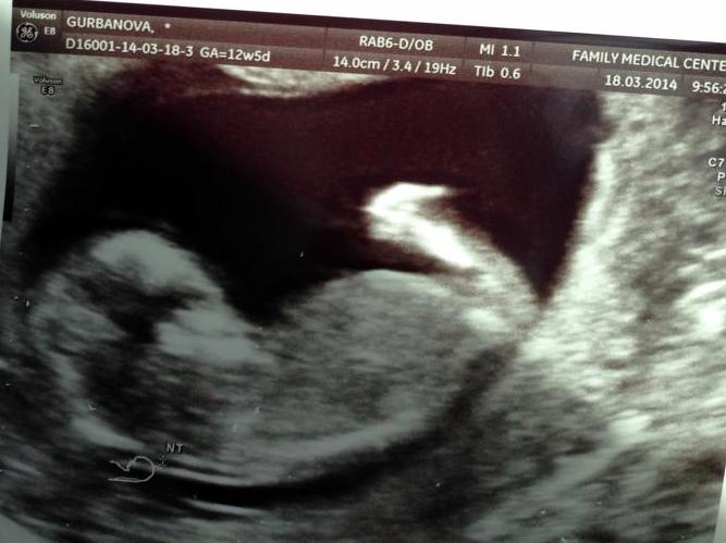 Наш первый скрининг!!! Здоровенький Малыш!!)))