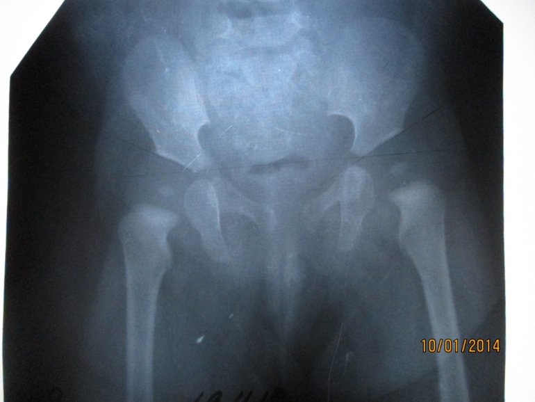 Дисплазия тазоб.суставов у ребенка - уточнение диагноза