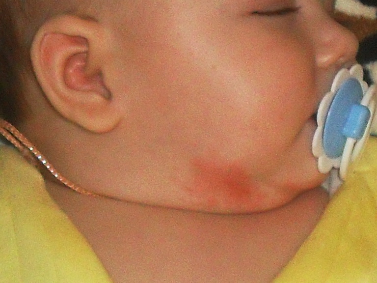 Диатез или потница?