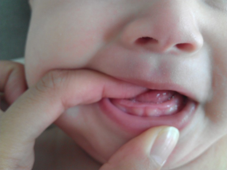 Еще про зюбы