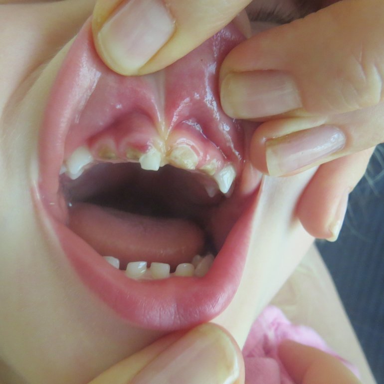 Кариес молочных зубов
