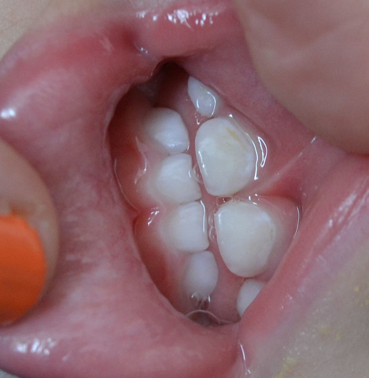 Бутылочный кариес