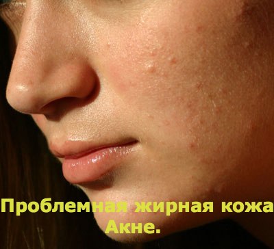 ПРОСТО НЕЗАМЕНИМЫЙ летом крем-бальзам для жирной и проблемной кожи!