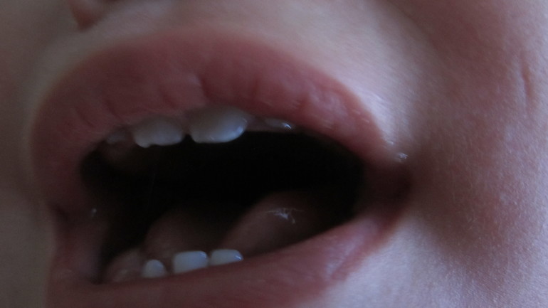 Что с зубками?