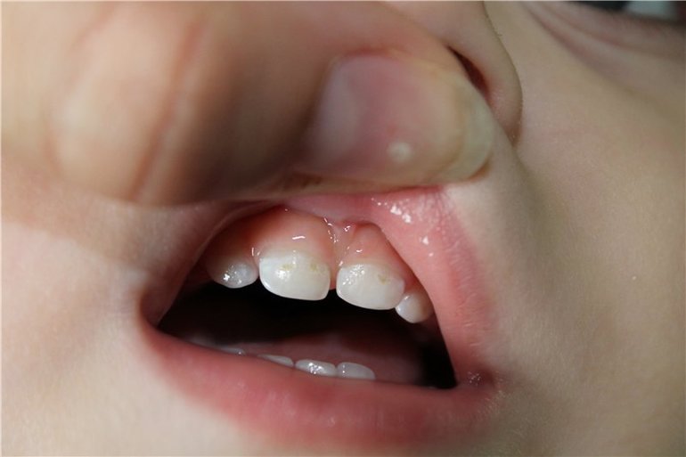 Налет или кариес молочных зубов?