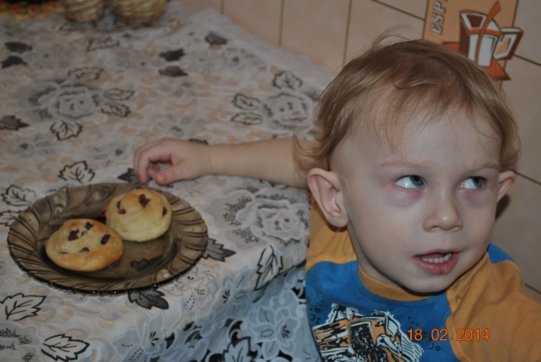 Мешки под глазами, врач сказала норма..