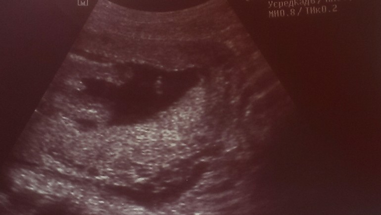 Сын) 18недель.Фото