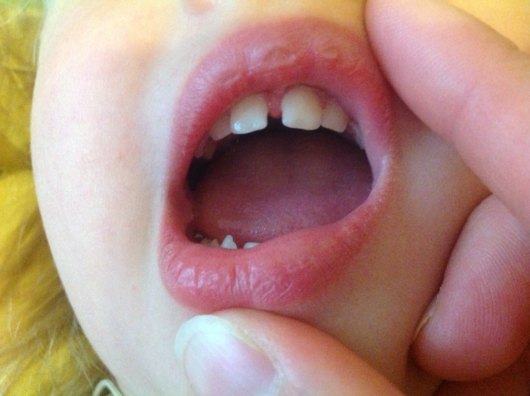 Нужно ли подрезать уздечку?