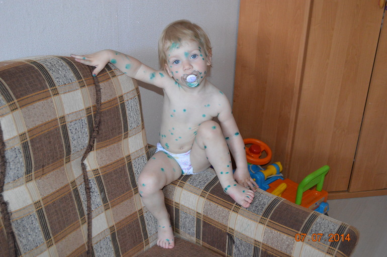 Наша ветрянка