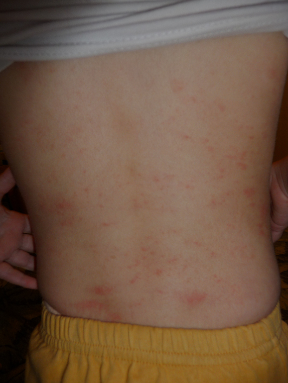 Что за сыпь?