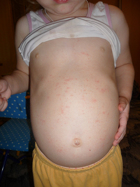 Что за сыпь?