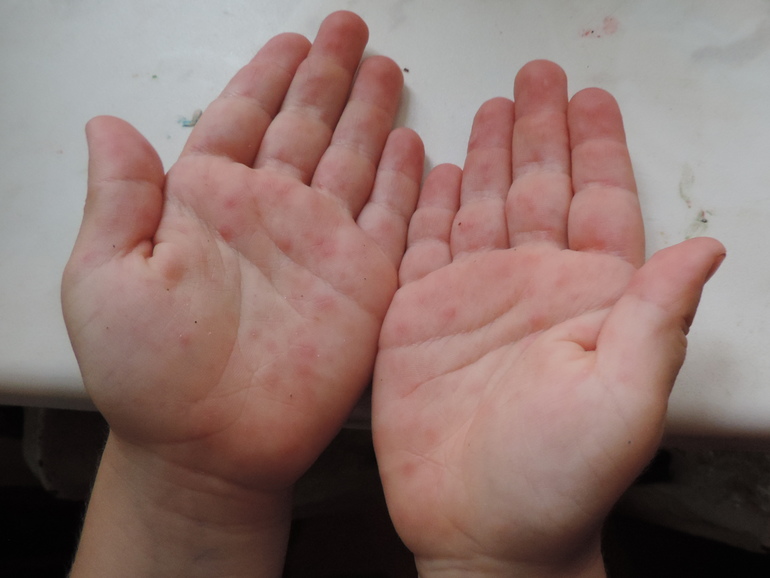 Красная сыпь на руках у взрослого: фото с описанием