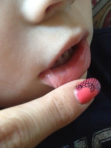 Молочница???