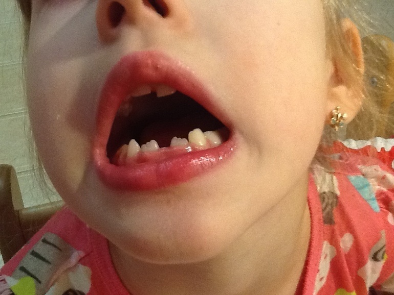 Бежать к ортодонту или подождать?