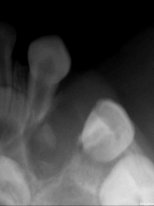 Набухла десна, с синевой. Ребнку 2 года 3 месяца.