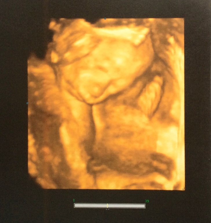 Внеплановое УЗИ 22-23 нед