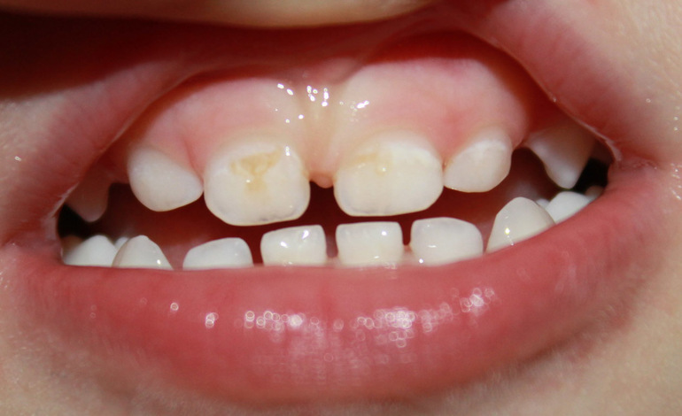 Бутылочный кариес.