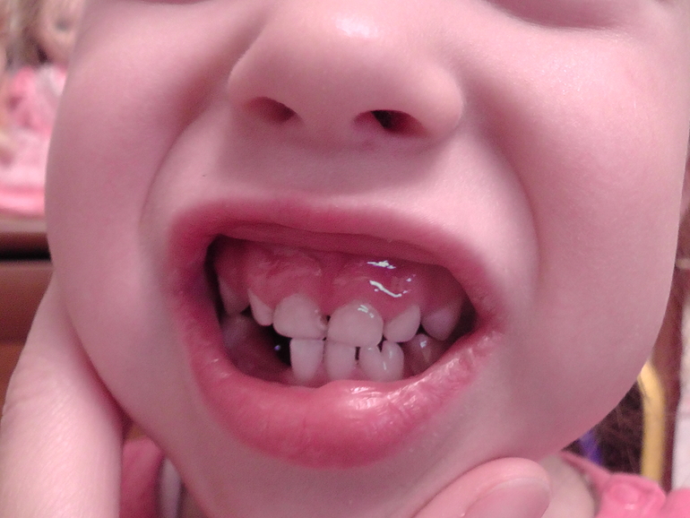 Возможно вылечить верхние средние резцы?