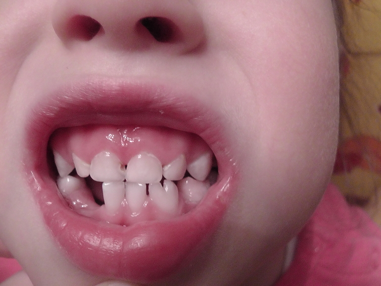 Возможно вылечить верхние средние резцы?