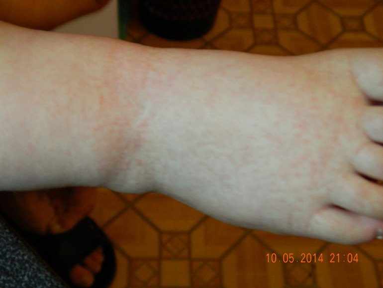 Помогите понять что это за сыпь!!!