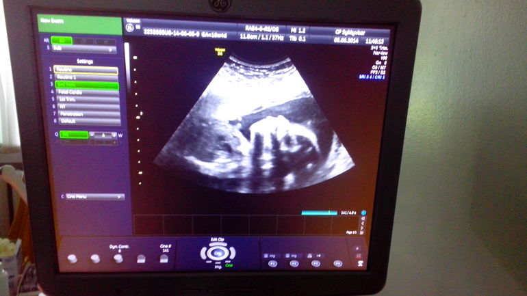 Позади 23 недели,пошла 24-ая,полет нормальный))))