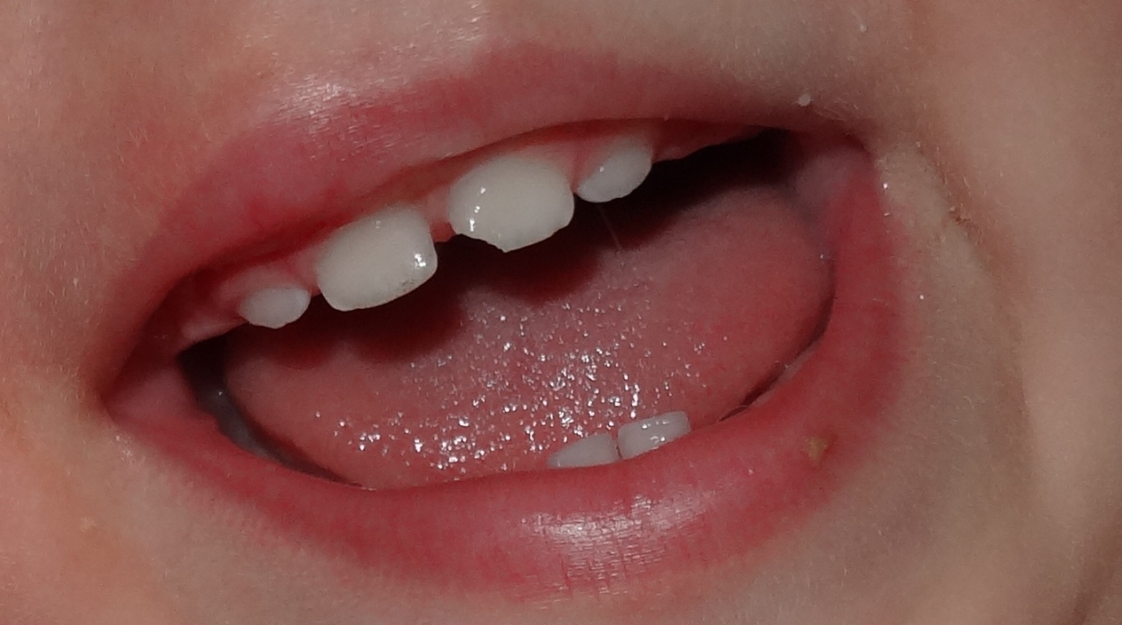 Откололся зуб.