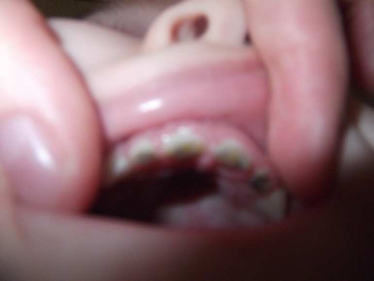 Фотографии Петеных зубов