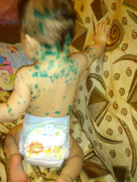 и все таки она пришла........ ветрянка!!!!!! День 1