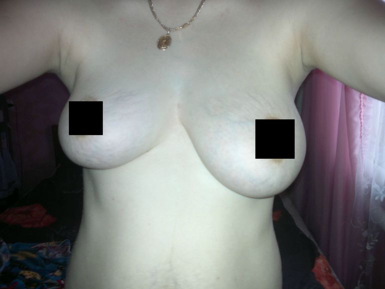 5 месяцев после кормления или ситуация с грудью не меняется(((