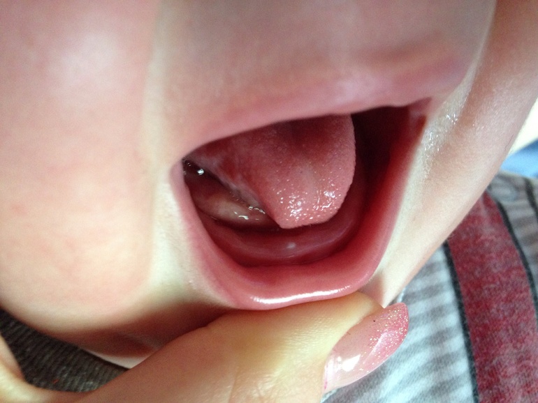 Был зуб и нет зуба((