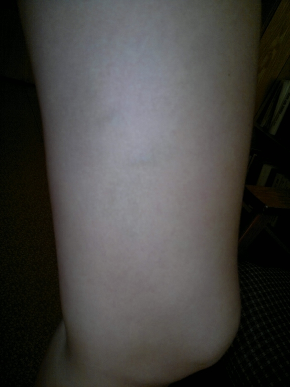 продолжение варикозной паранои.) фотки. ничего нового не увидите...