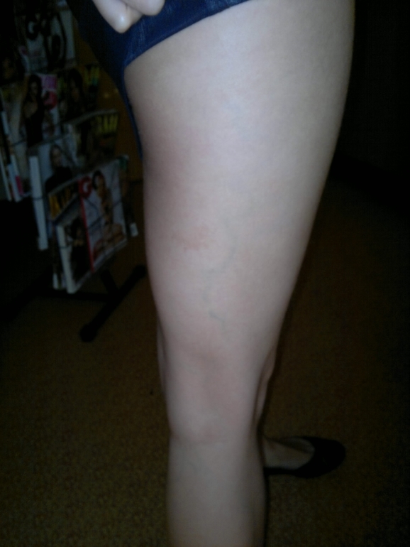 продолжение варикозной паранои.) фотки. ничего нового не увидите...