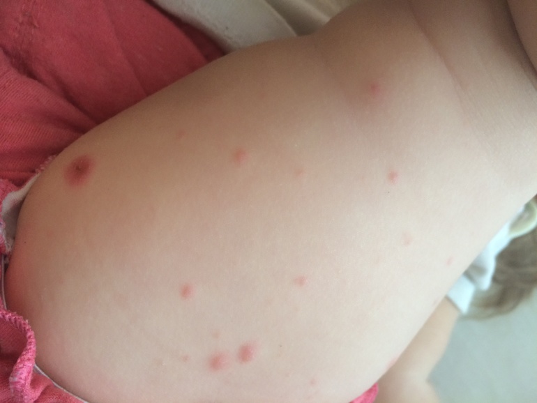 Определяем сыпь по фото - все виды Определяем сыпь по фото - все виды