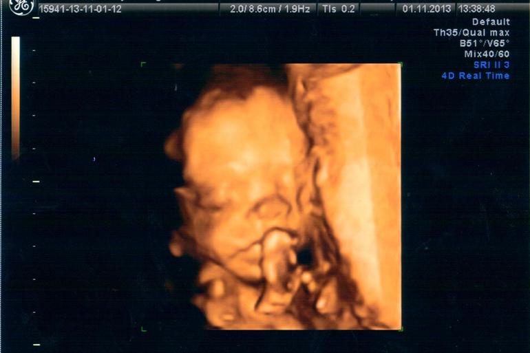 20 недель (Наш экватор + 2 плановое УЗИ)