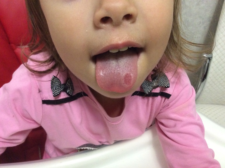 Желтый налет на языке у ребенка: причины и лечение, признак какого заболевания